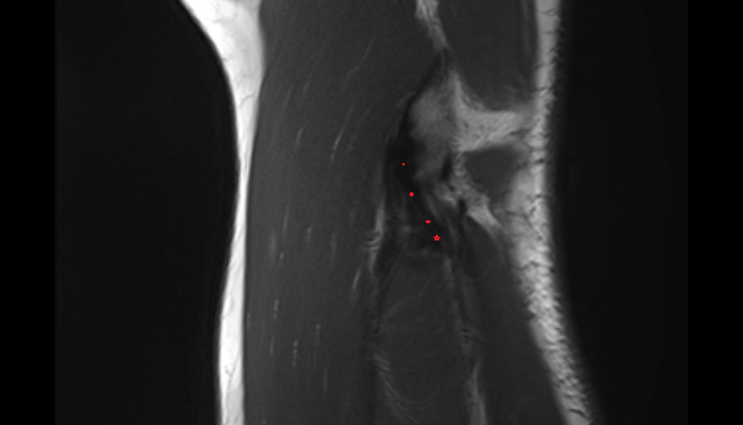 Lateral ulnar collateral ligament sag cross sectional anatomy 3T MRI AI enhanced radiology image -img-00000-00000