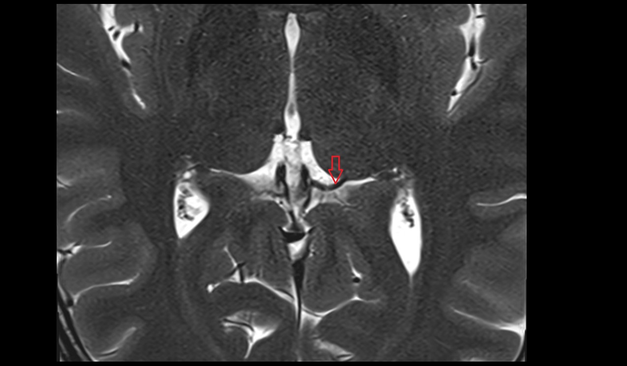 Lateral vein of lateral ventricle MRI 3T axial image