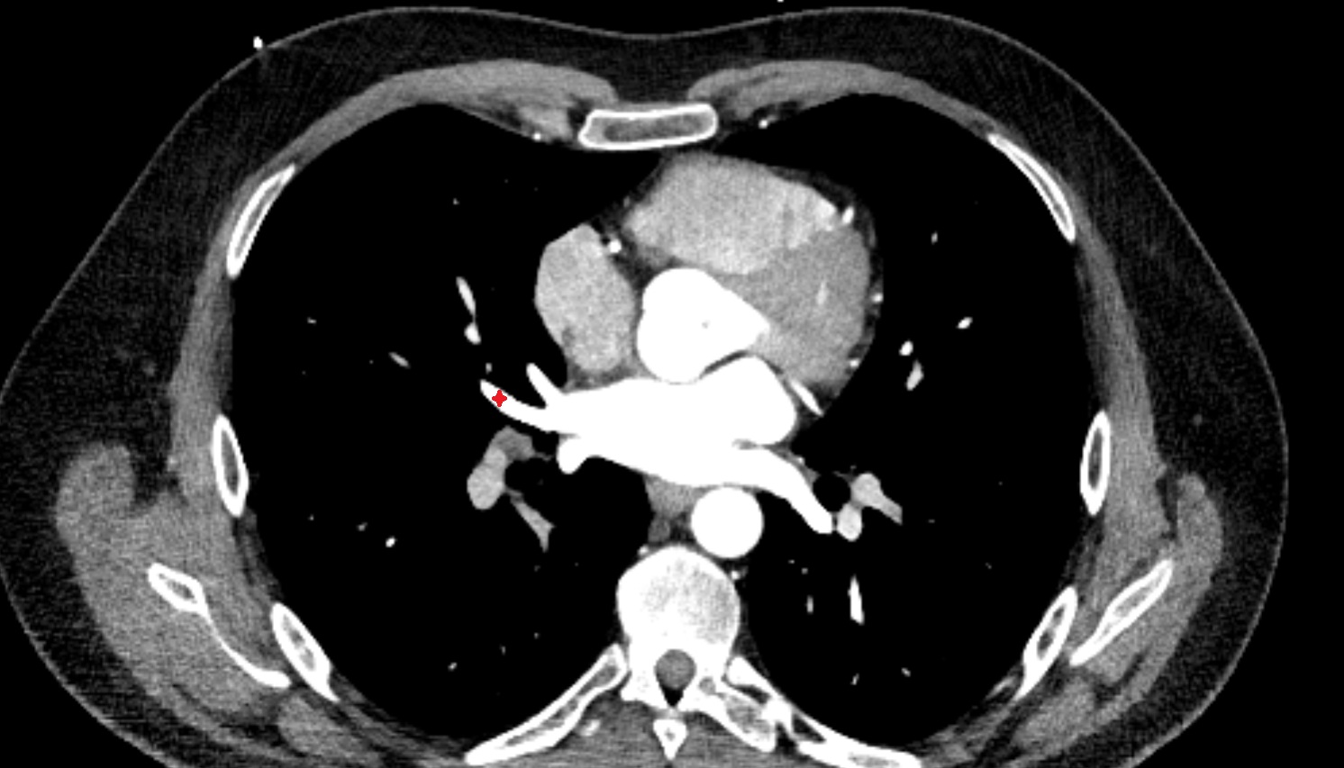 Lateral vein of right lung anatomy CT axial  image -img-00000-00000