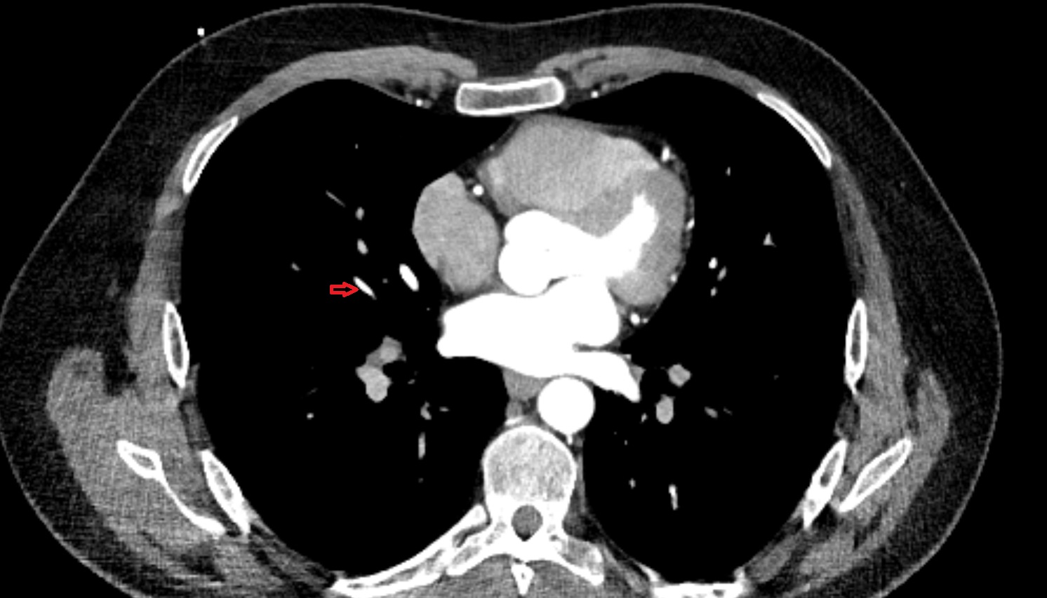 Lateral vein of right lung anatomy CT axial  image -img-00000-00000_00001