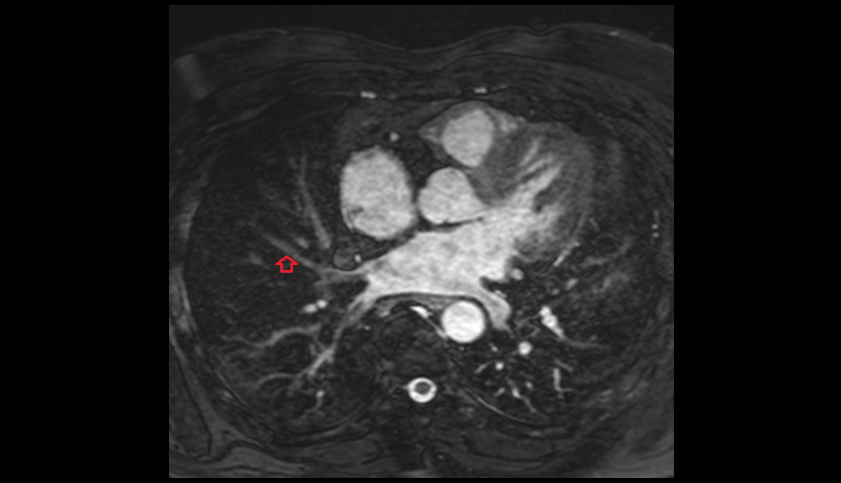 Lateral vein of right lung mri axial image