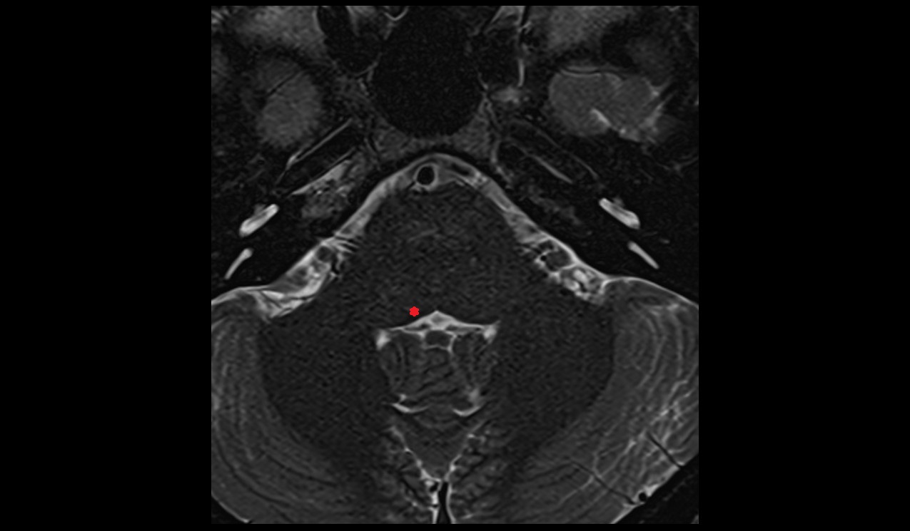 Lateral vestibular nucleus mri 3t image