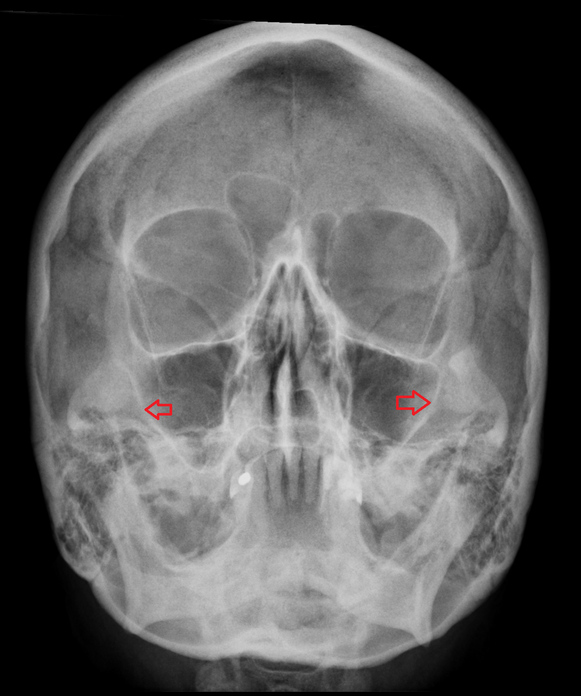Lateral wall of maxillary sinus