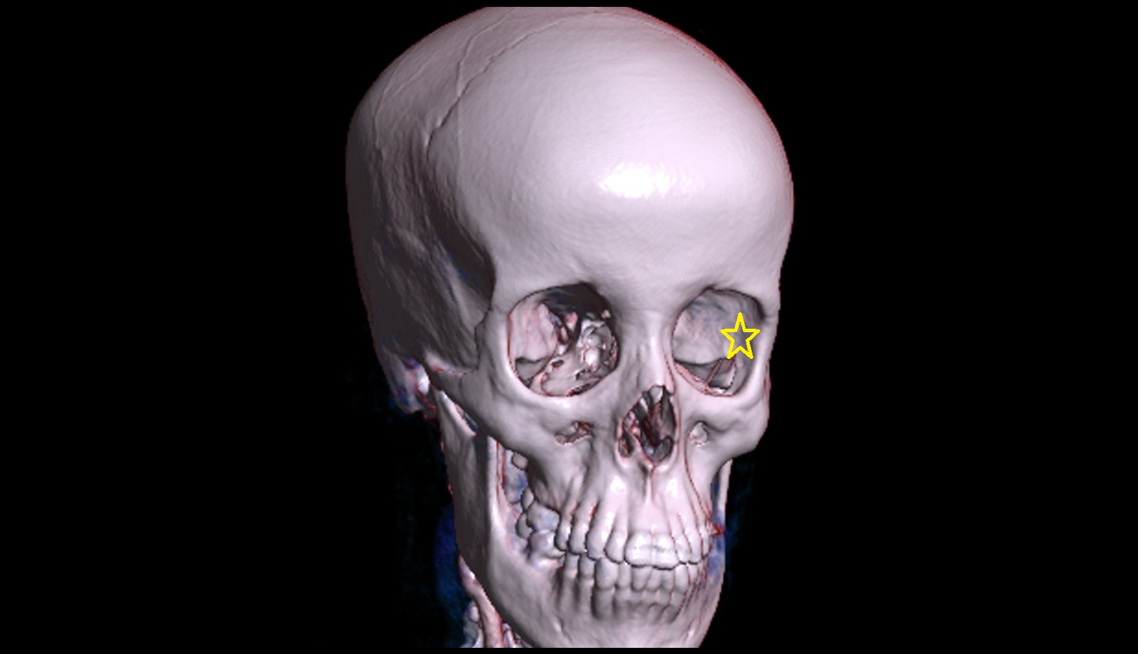 Lateral wall of orbit 3d