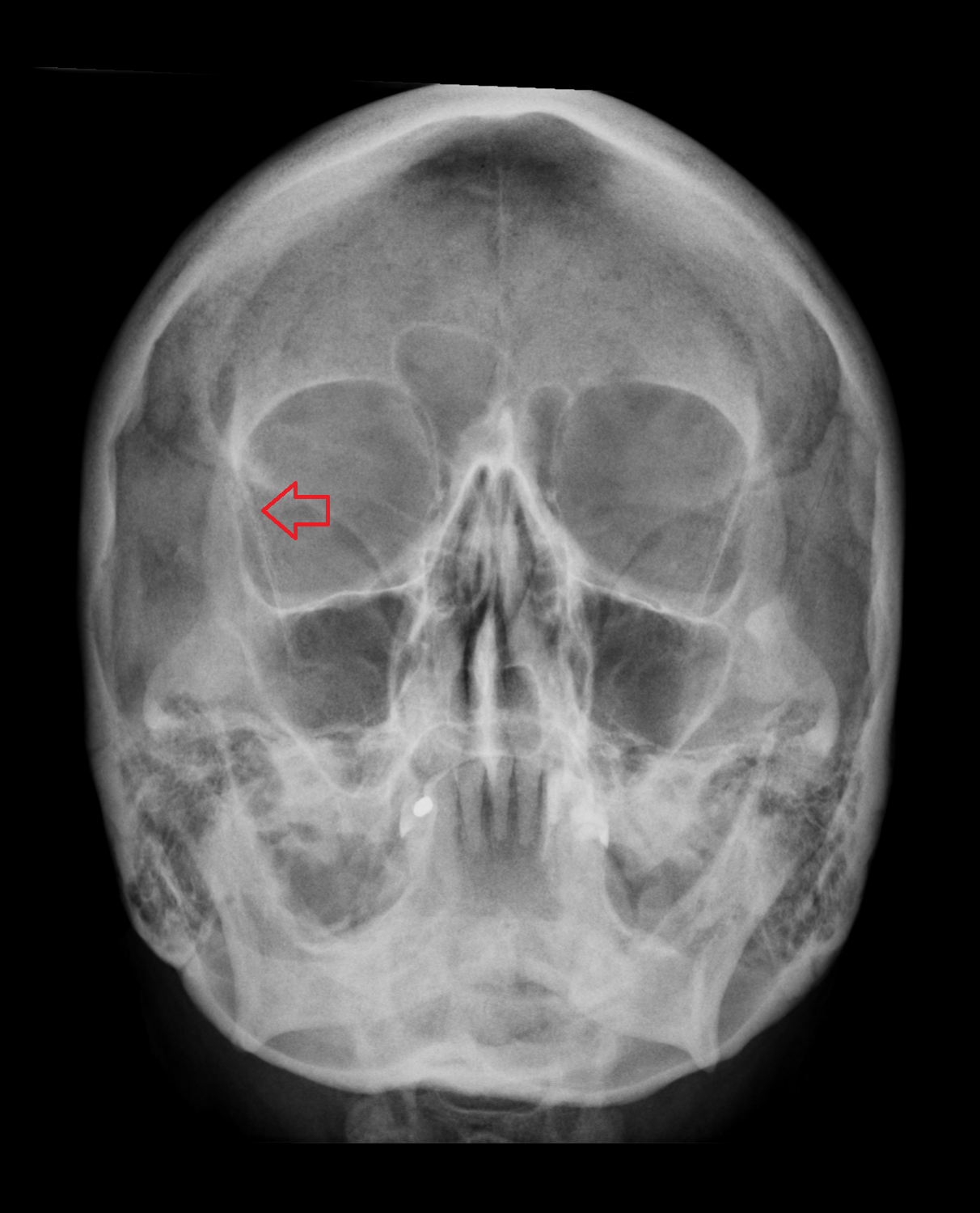 Lateral wall of the orbit x ray