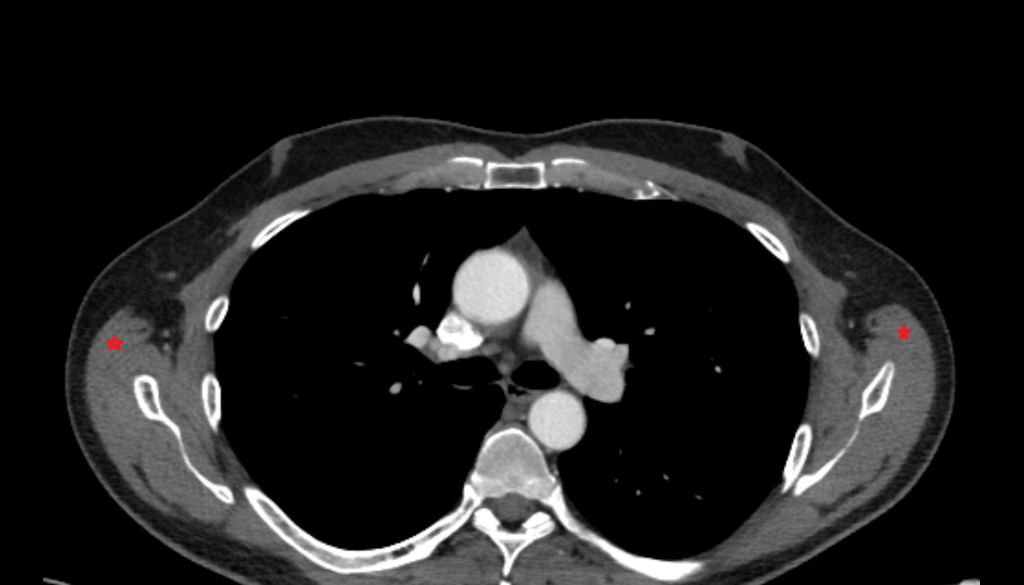 Latissimus dorsi muscle  anatomy CT axial  image -img-00000-00000