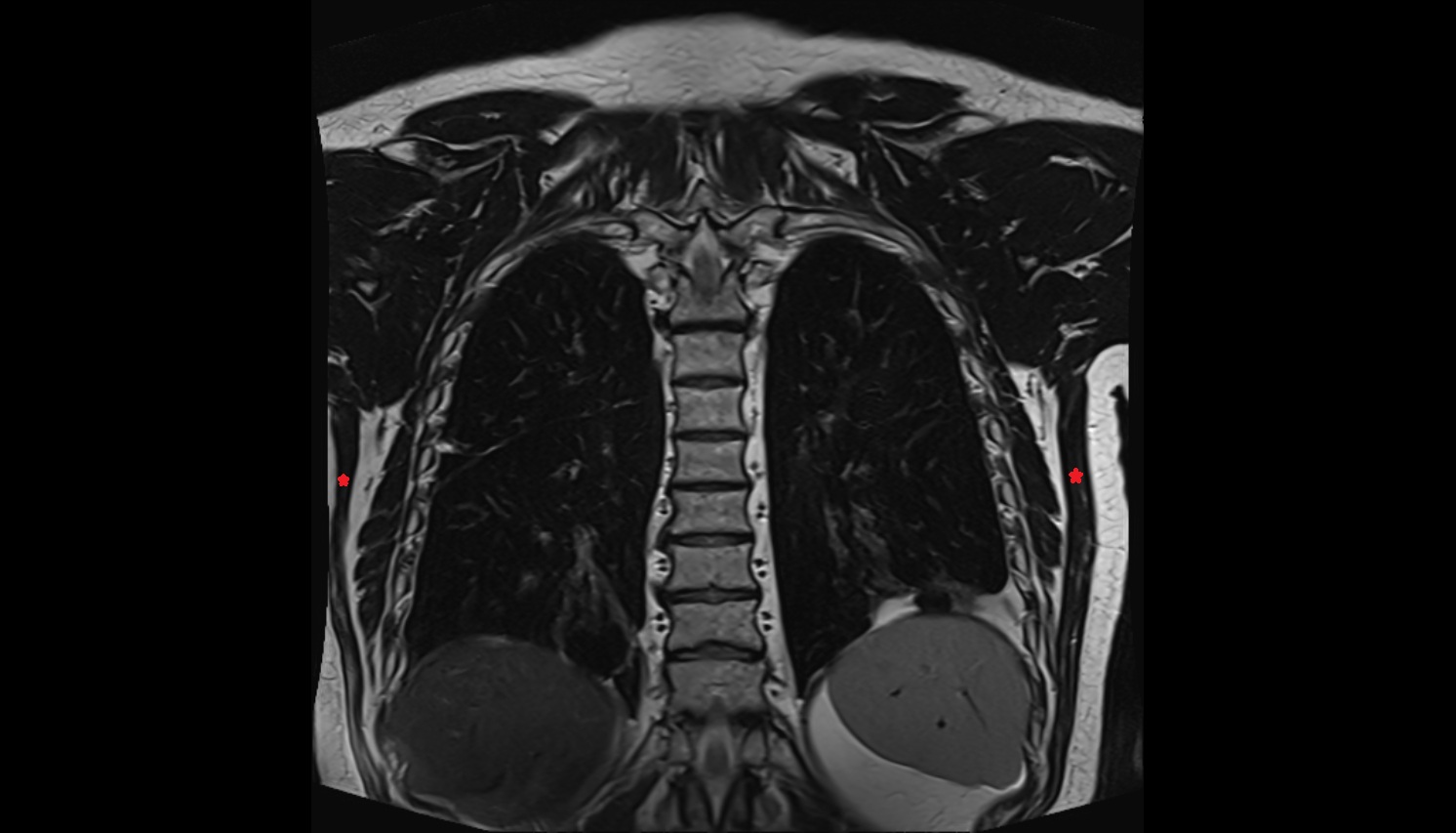 Latissimus dorsi muscle  anatomy MRI coronal  image -img-00000-00000