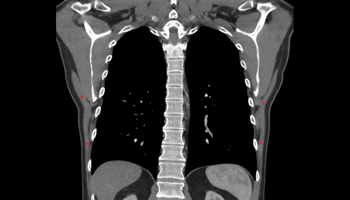 Latissimus dorsi muscle  anatomy ct coronal  image -img-00000-00000
