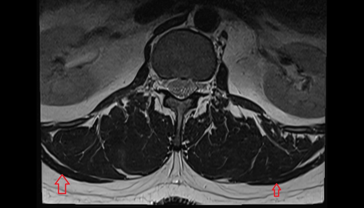 Latissimus dorsi muscle  mri  axial  anatomy  image-img-00000-00000