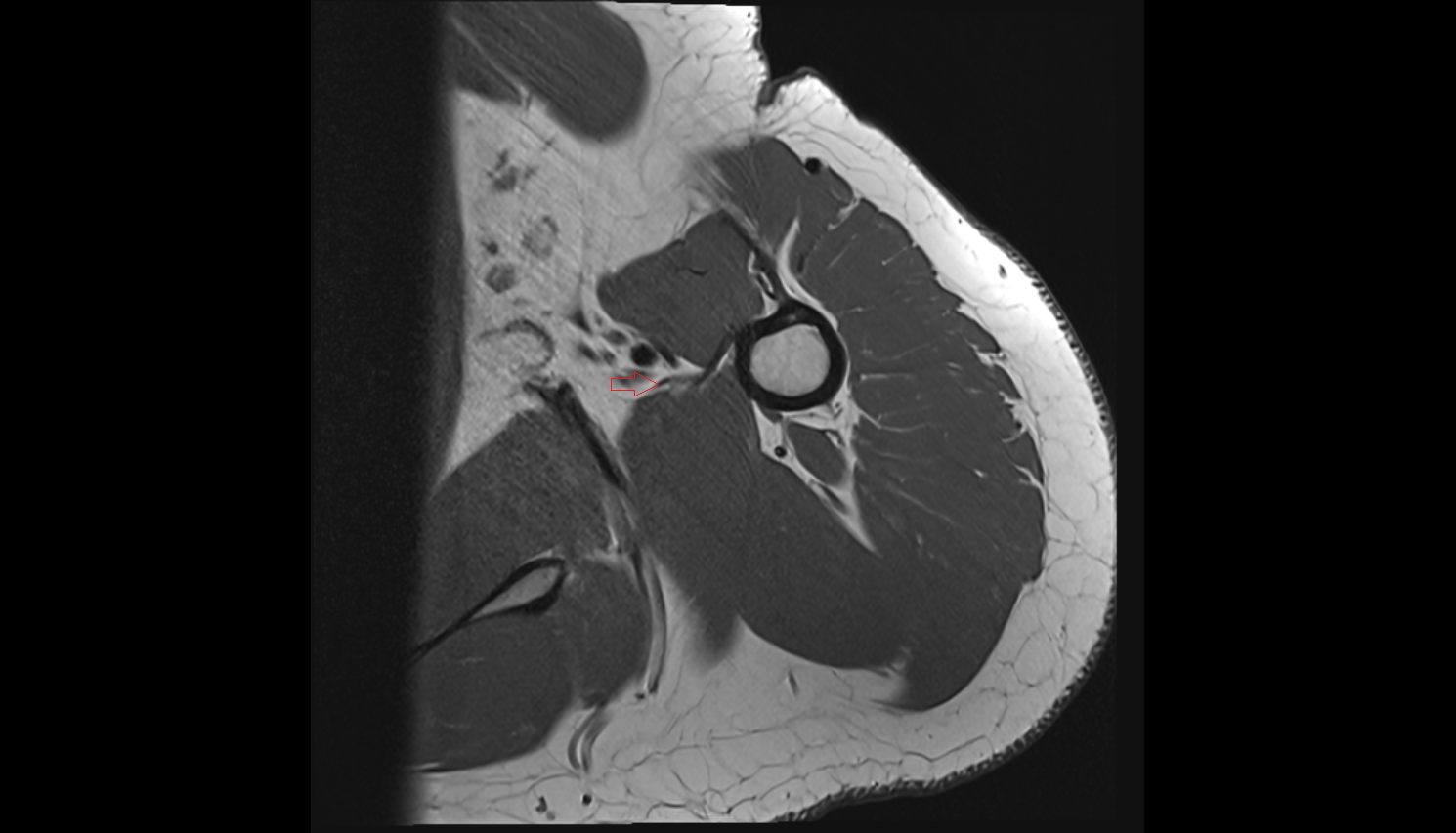 Latissimus dorsi tendon axial cross sectional anatomy 3T MRI AI enhanced radiology image-img-00000-00000