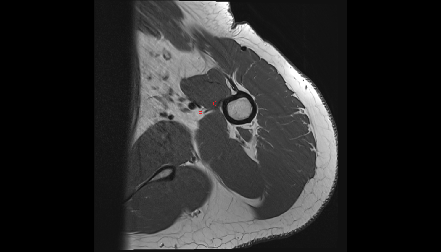 Latissimus dorsi tendon axial cross sectional anatomy 3T MRI AI enhanced radiology image-img-00000-00000_00001