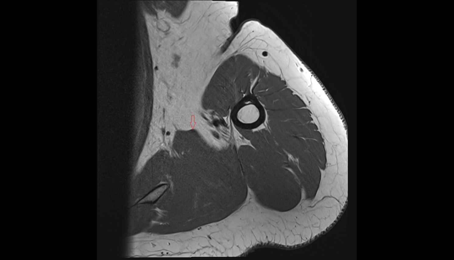 Latissimus dorsi tendon axial cross sectional anatomy 3T MRI AI enhanced radiology image-img-00000-00000_00002