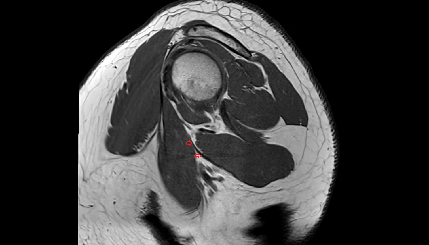 Latissimus dorsi tendon sag cross sectional anatomy 3T MRI AI enhanced radiology image-img-00000-00000_00003