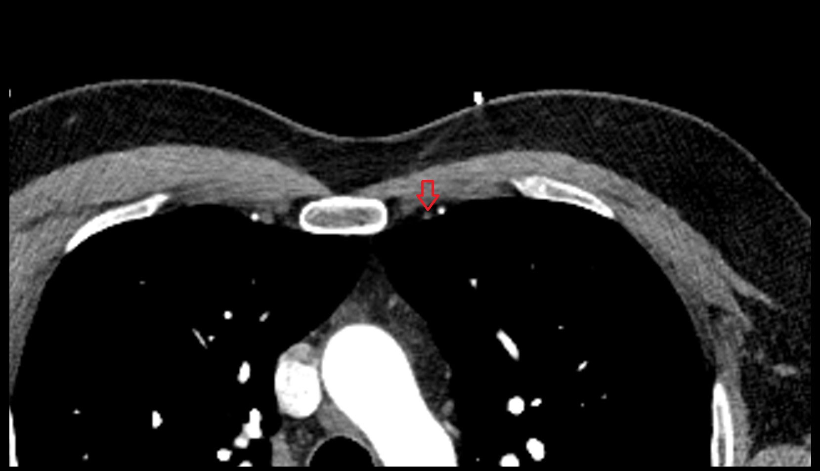 Left Internal Thoracic Veins  Anatomy ct axial