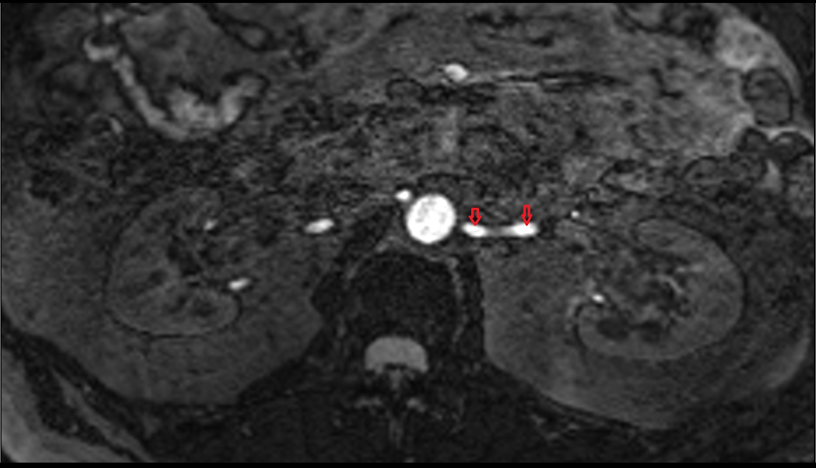 Left Renal Artery AXIAL