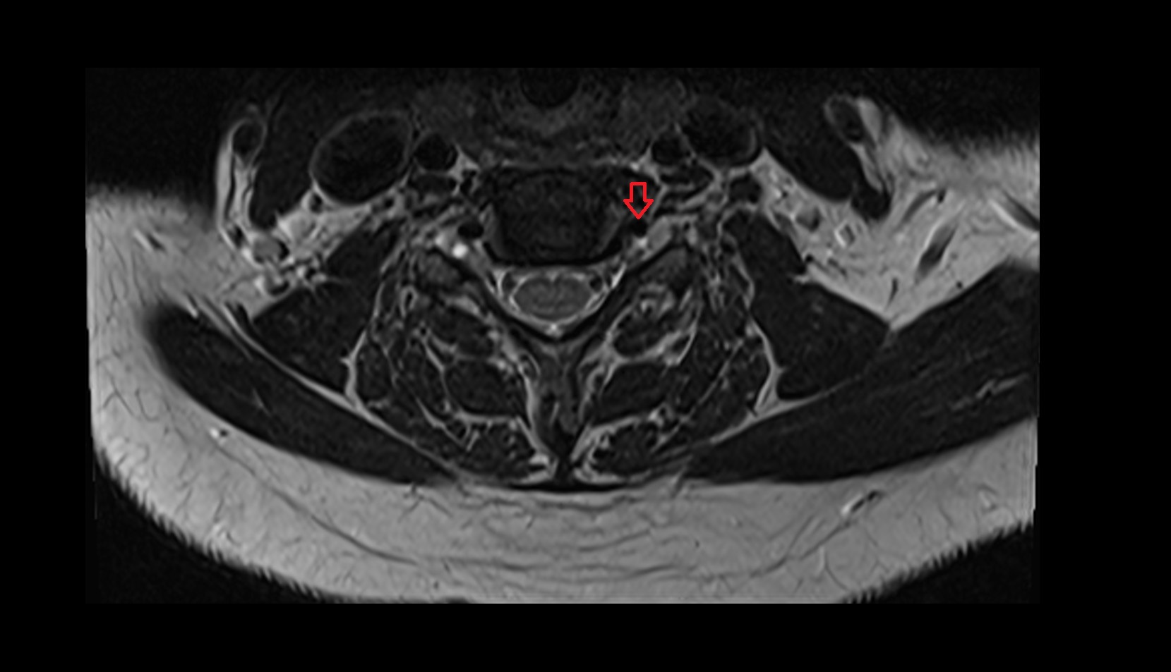 Left Vertebral Artery (Cervical Part) mri axial image