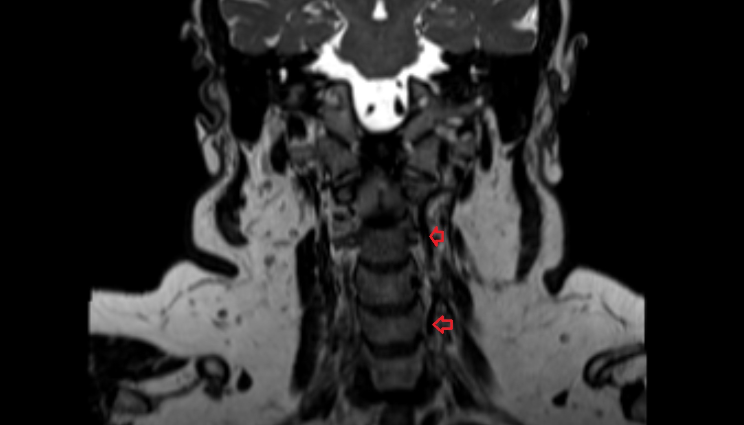Left Vertebral Artery (Cervical Part)  mri coronal image -img-00000-00000