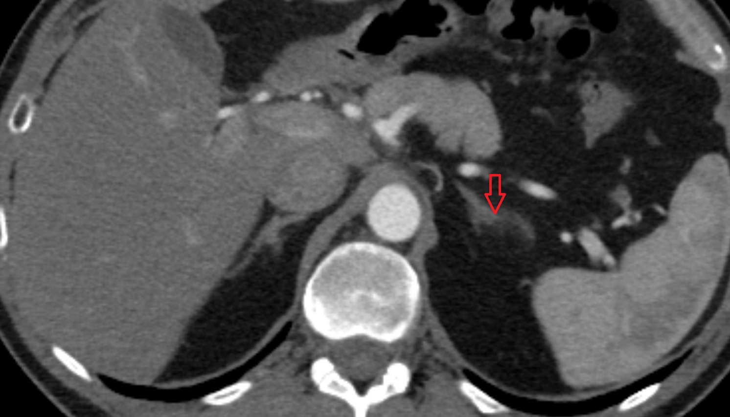Left  adrenal gland  anatomy CT axial  image -img-00000-00000