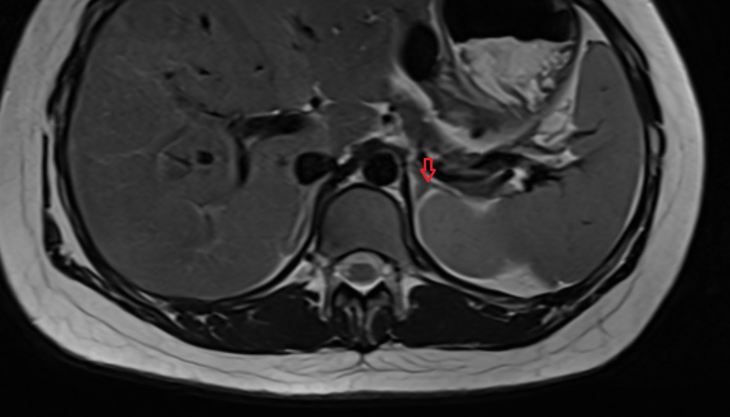 Left  adrenal gland  anatomy  MRI axial