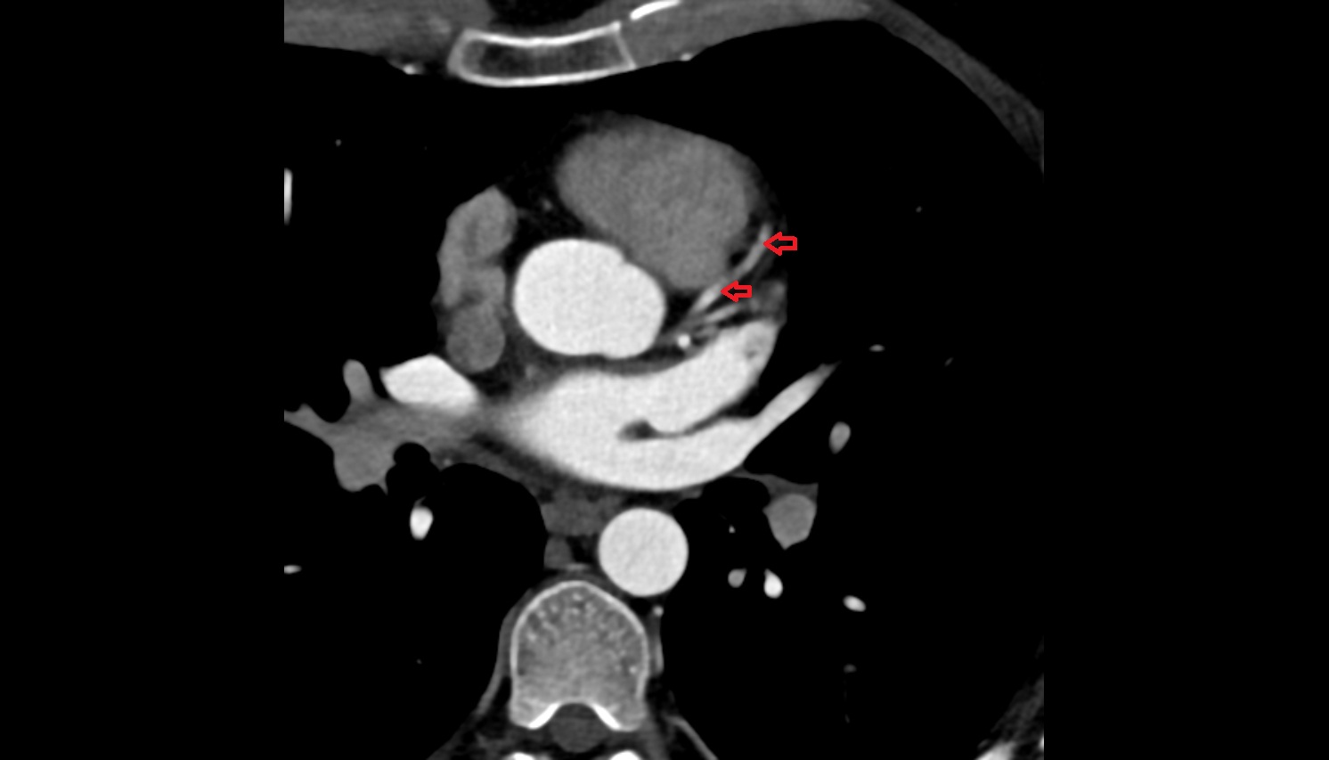 Left anterior descending artery (LAD)   anantomy  CT  axial image -img-00000-00000