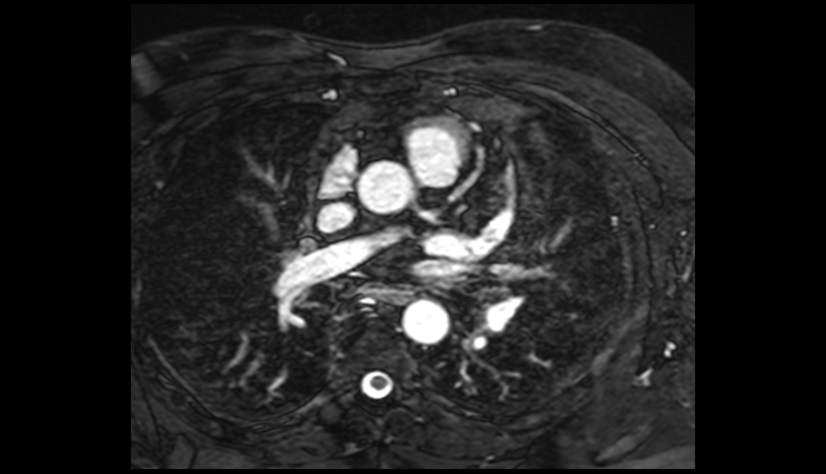 Left anterior descending artery (LAD) mri axial image