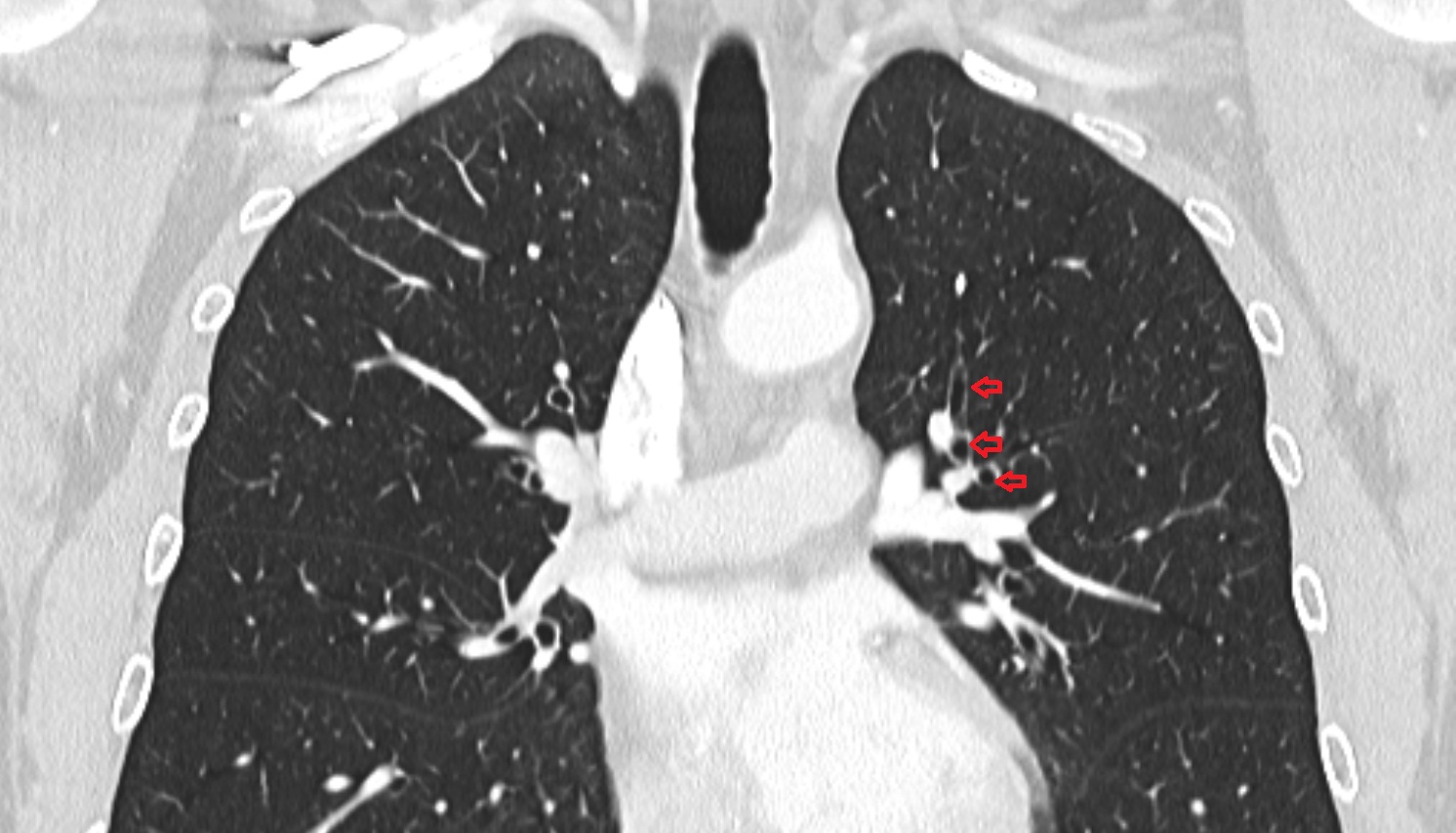 Left anterior segmental bronchus (B3a, B3b, B3c)  anatomy  CT coronal  image -img-00000-00000