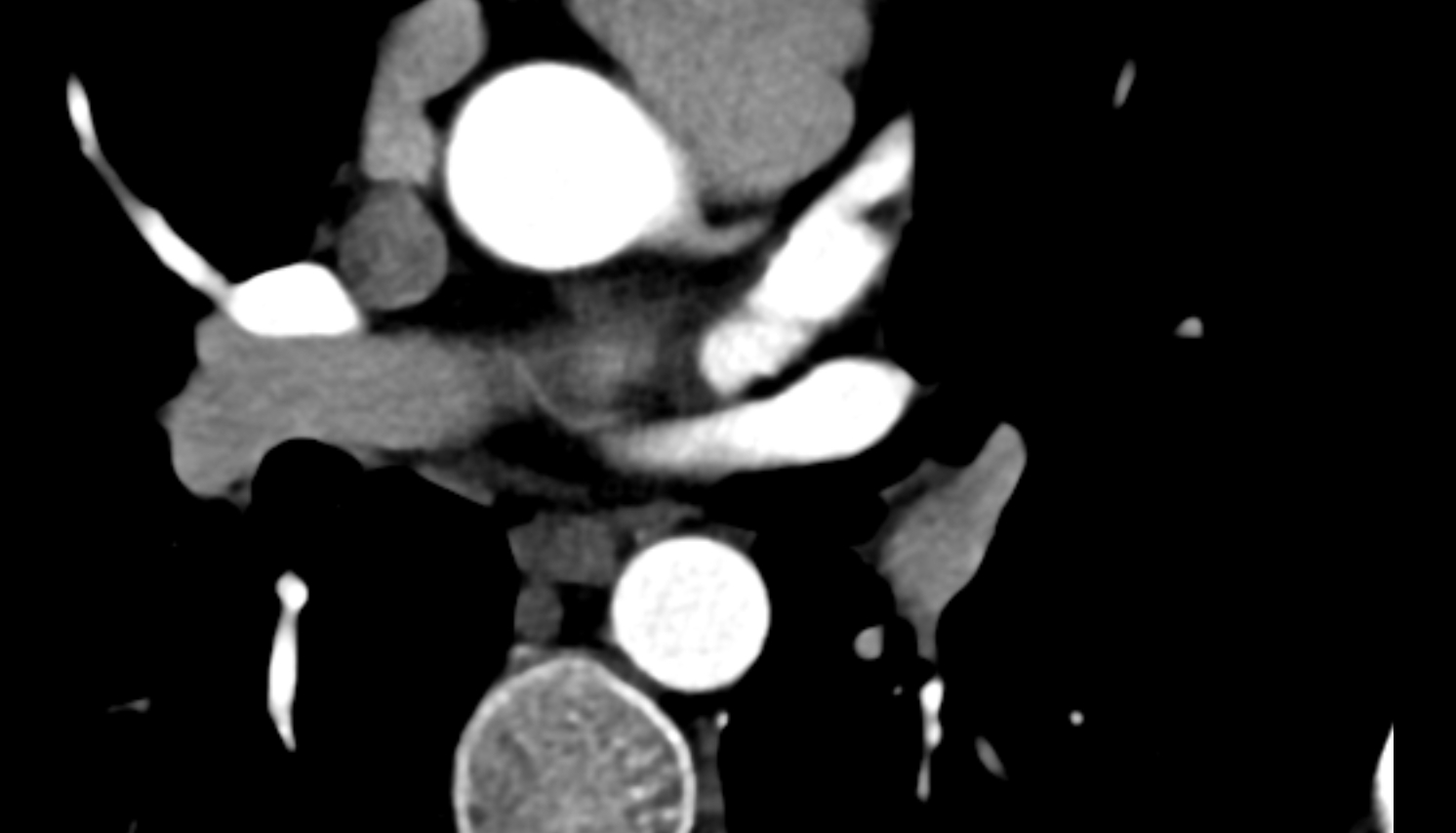 Left atrial branch anatomy  CT axial   image -img-00000-00000