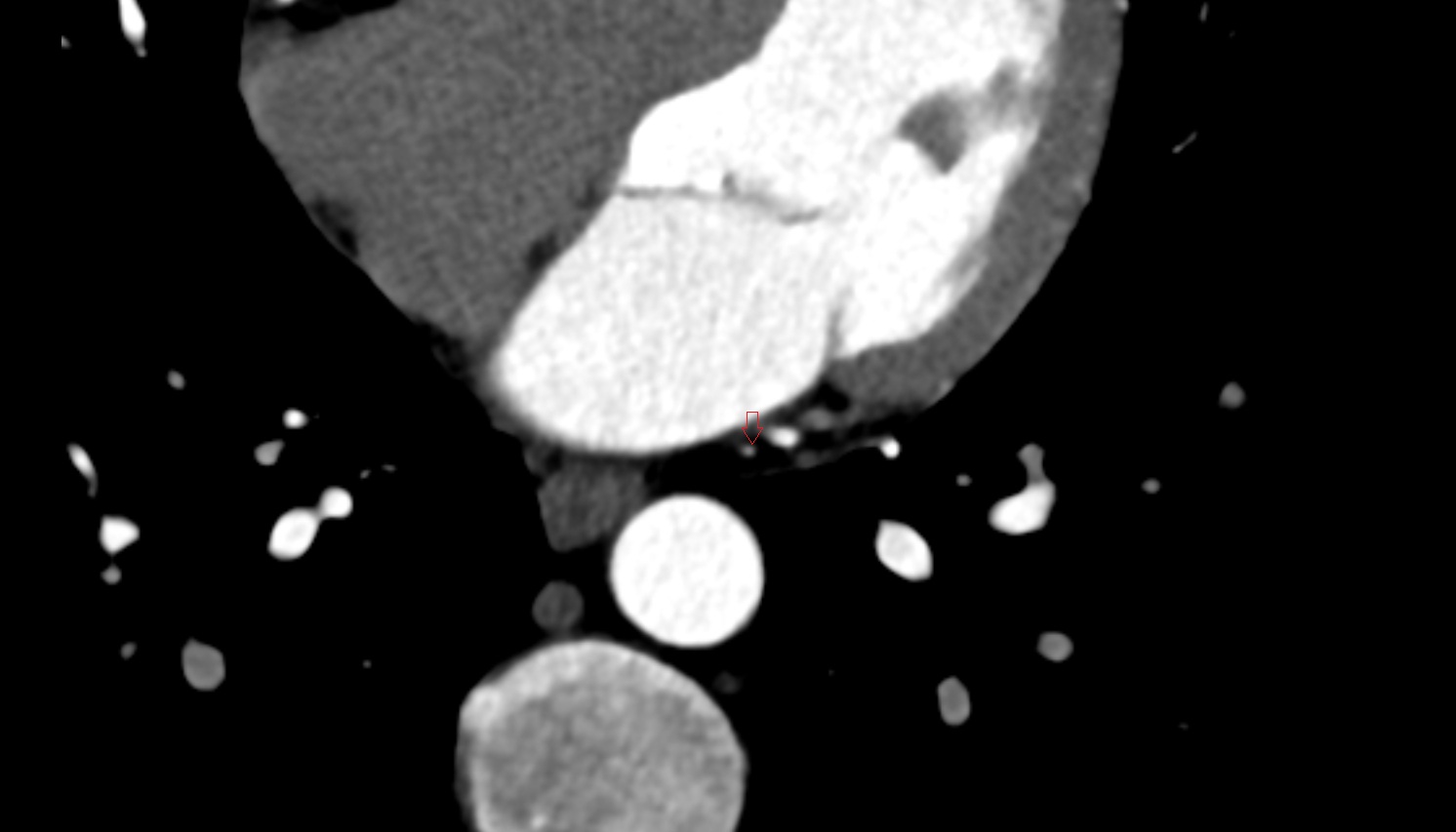 Left atrial branch anatomy  CT axial   image -img-00000-00000_00001