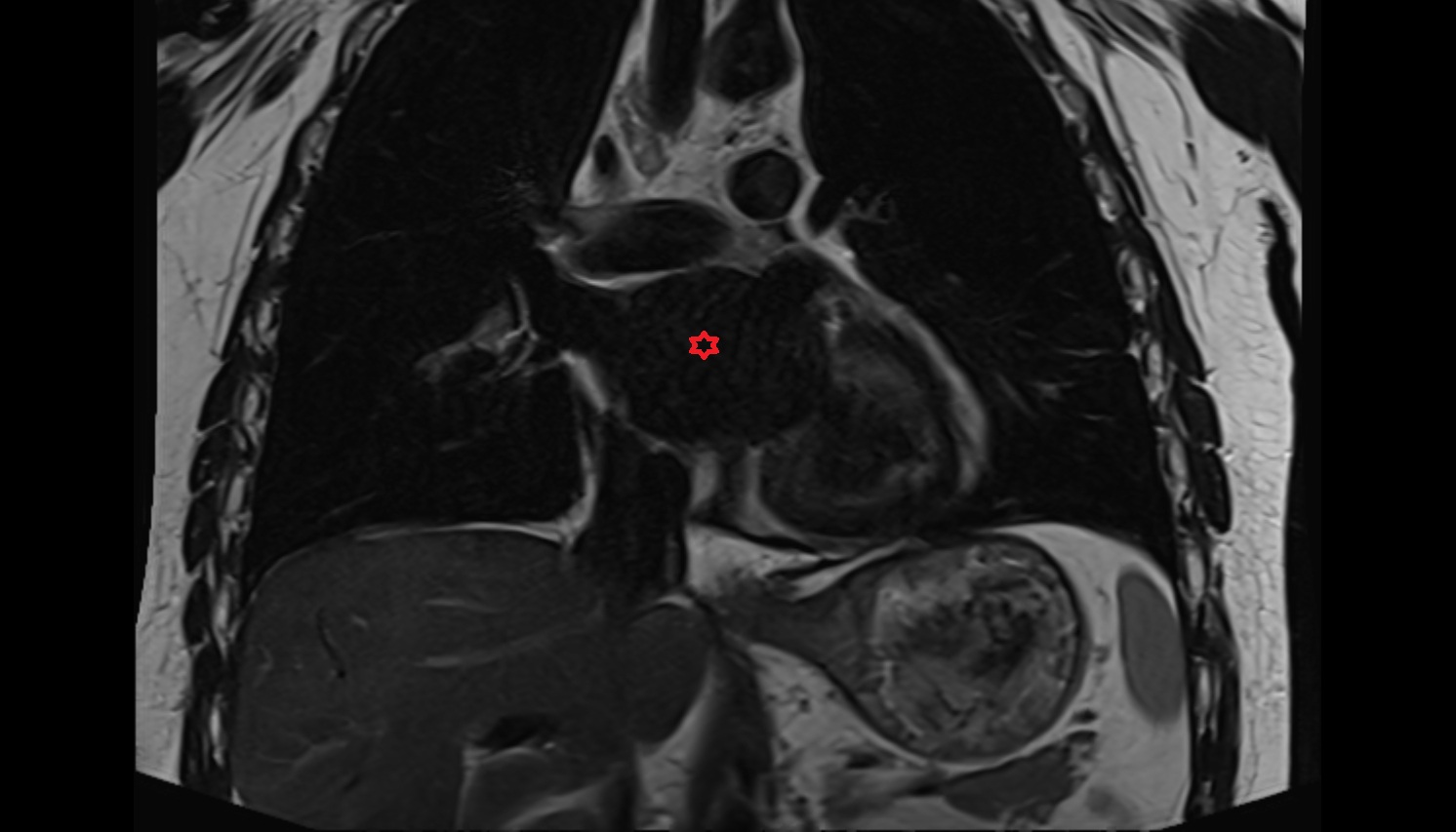Left atrium  MRI coronal image -img-00000-00000