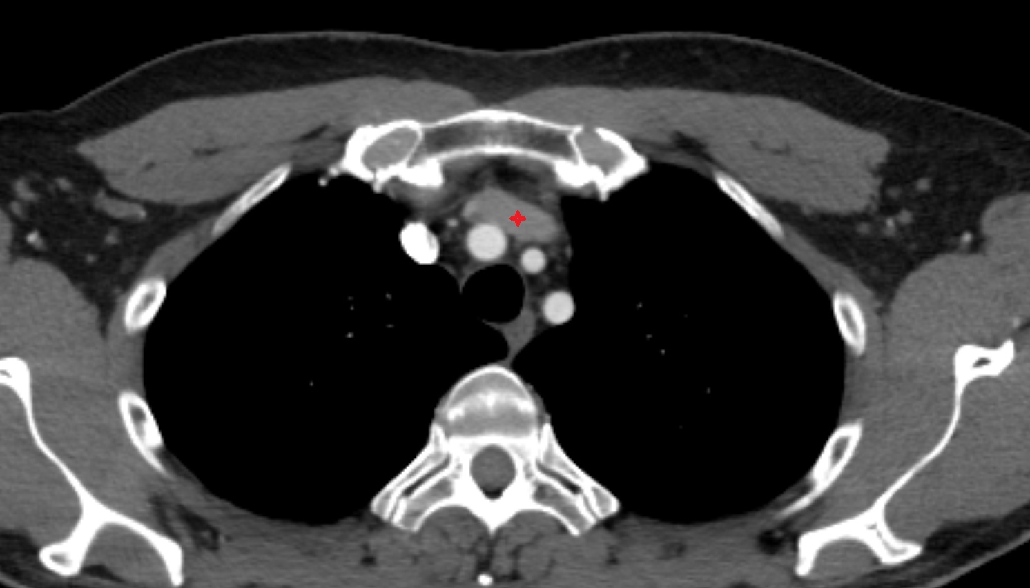 Left brachiocephalic vein anatomy axial  CT  image -img-00000-00000