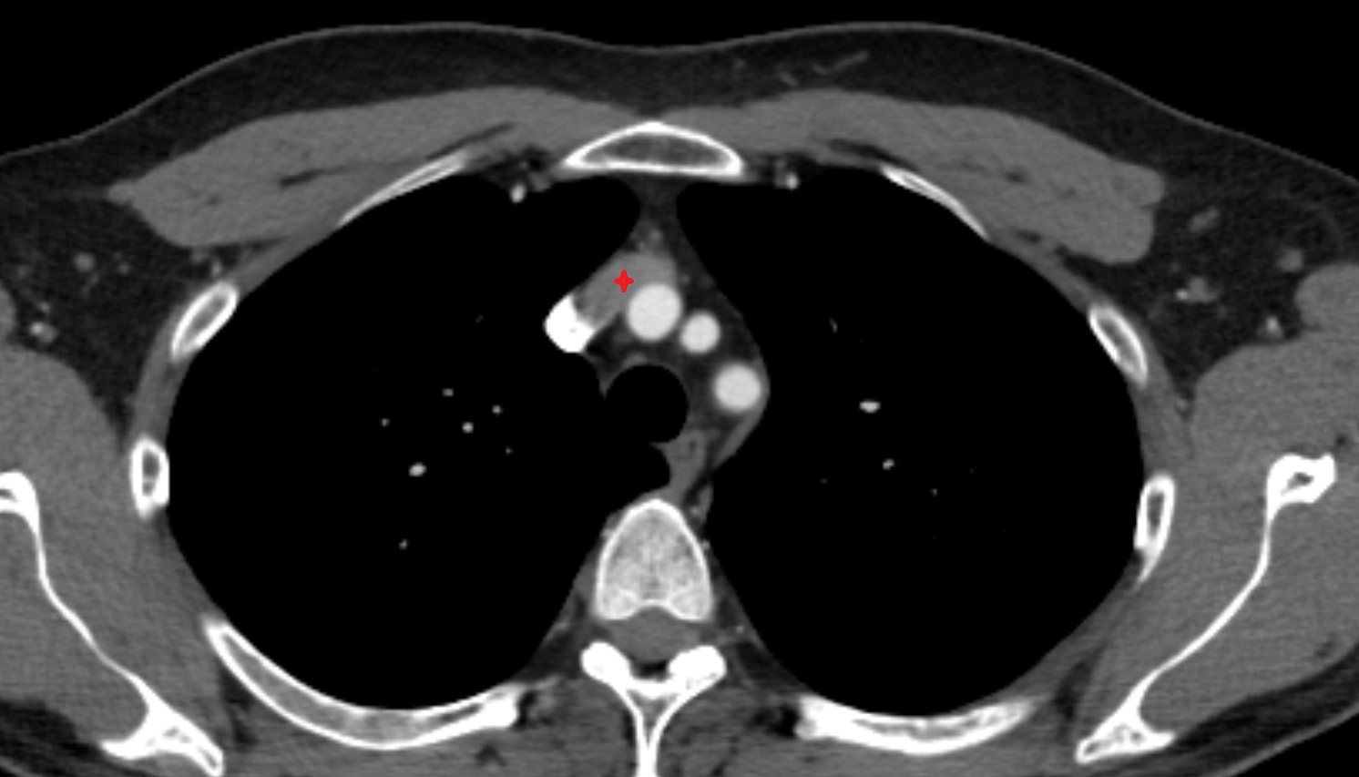 Left brachiocephalic vein anatomy axial  CT  image -img-00000-00000_00001