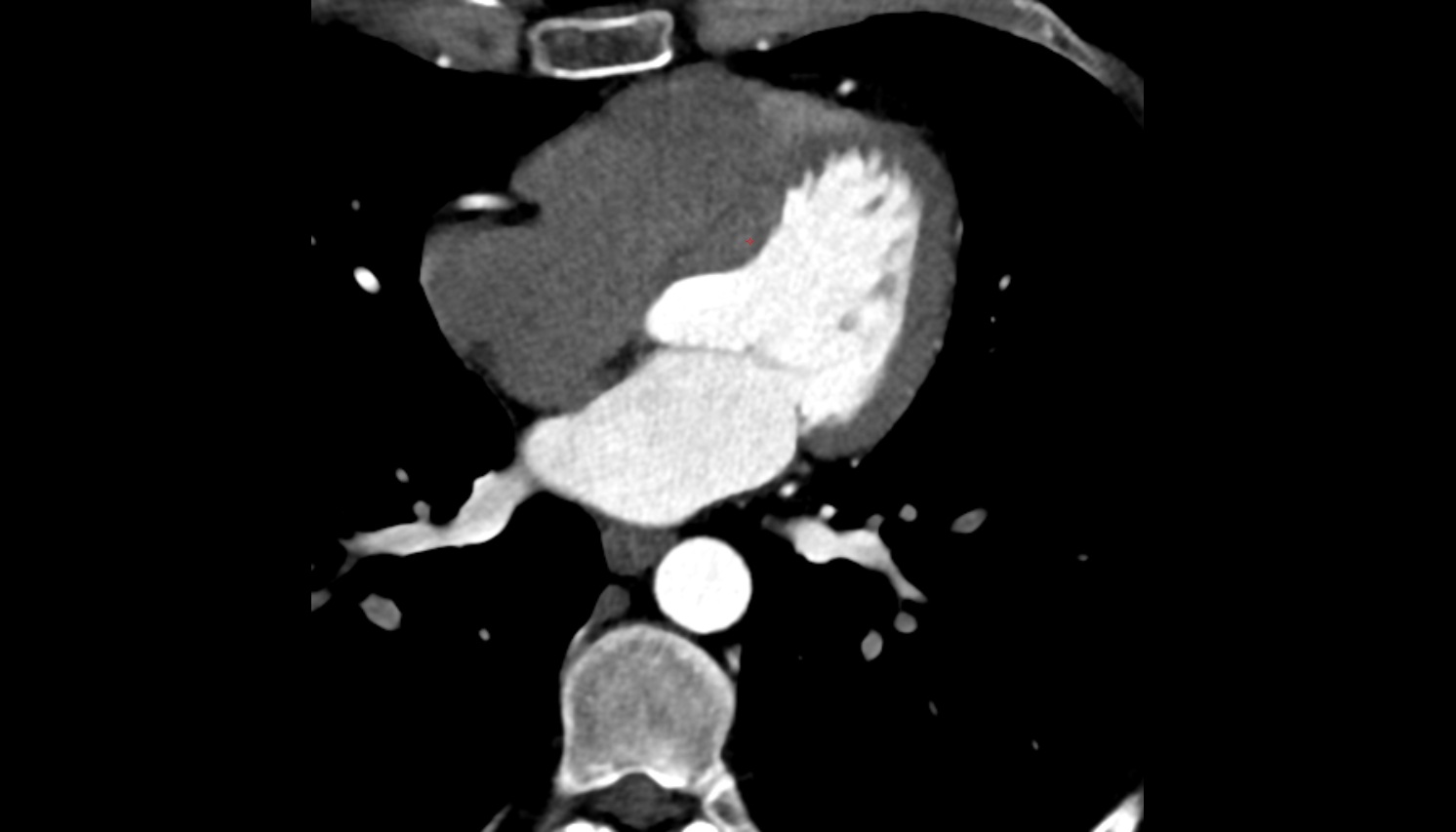 Left branch of atrioventricular bundle  anatomy  CT axial   image -img-00000-00000