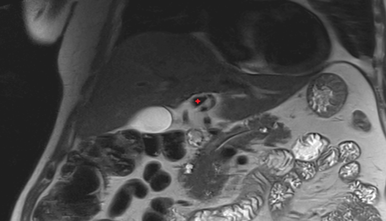 Left branch of hepatic portal vein MRI coronal  anatomy  image -img-00000-00000
