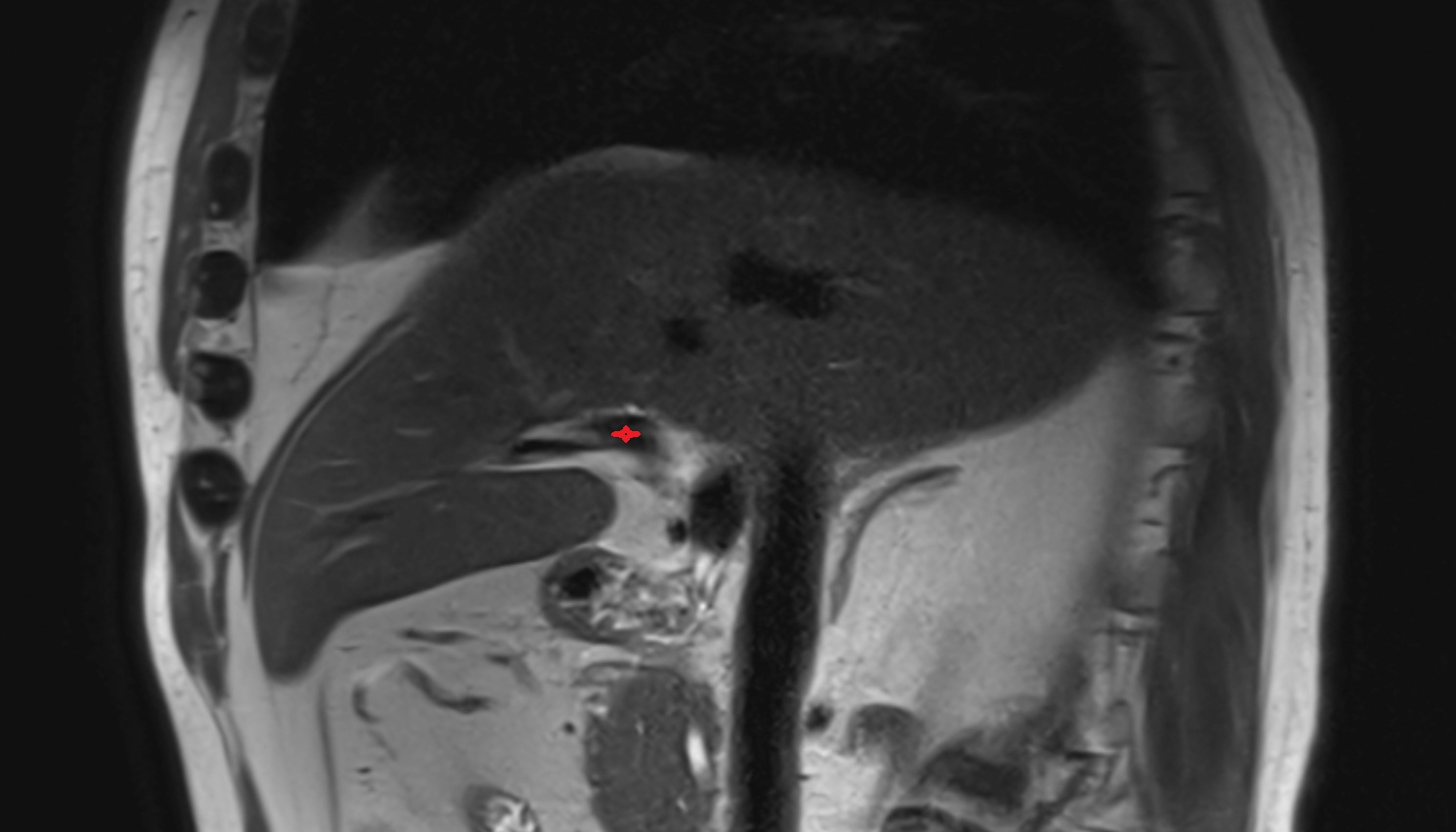 Left branch of hepatic portal vein MRI sag anatomy  image -img-00000-00000