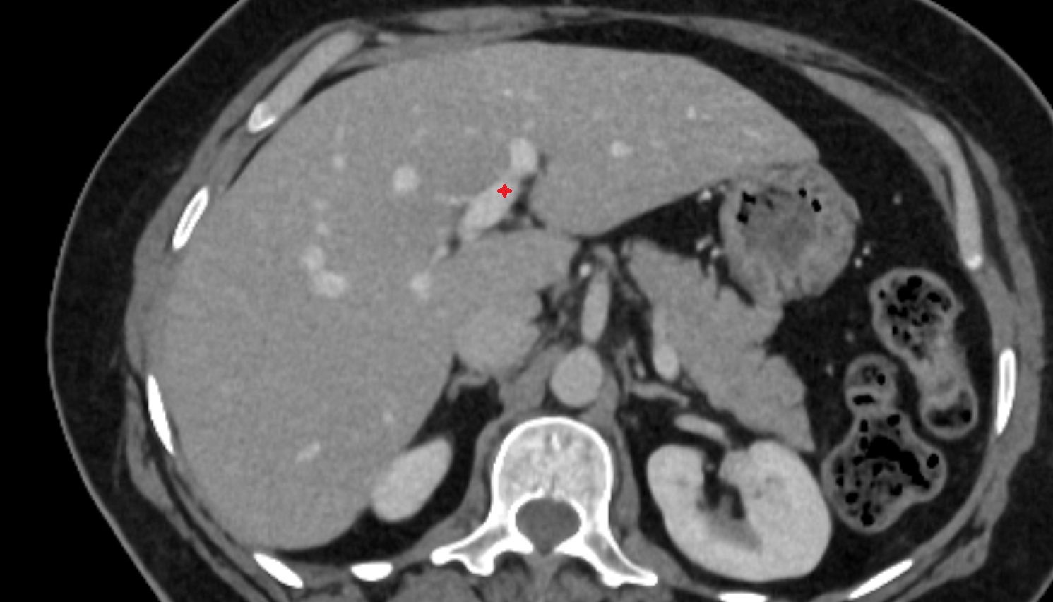 Left branch of hepatic portal vein ct  axial  anatomy  image -img-00000-00000