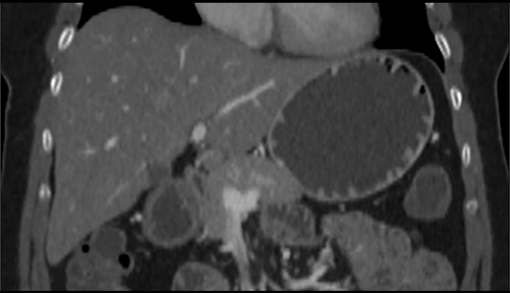 Left branch of hepatic portal vein ct image