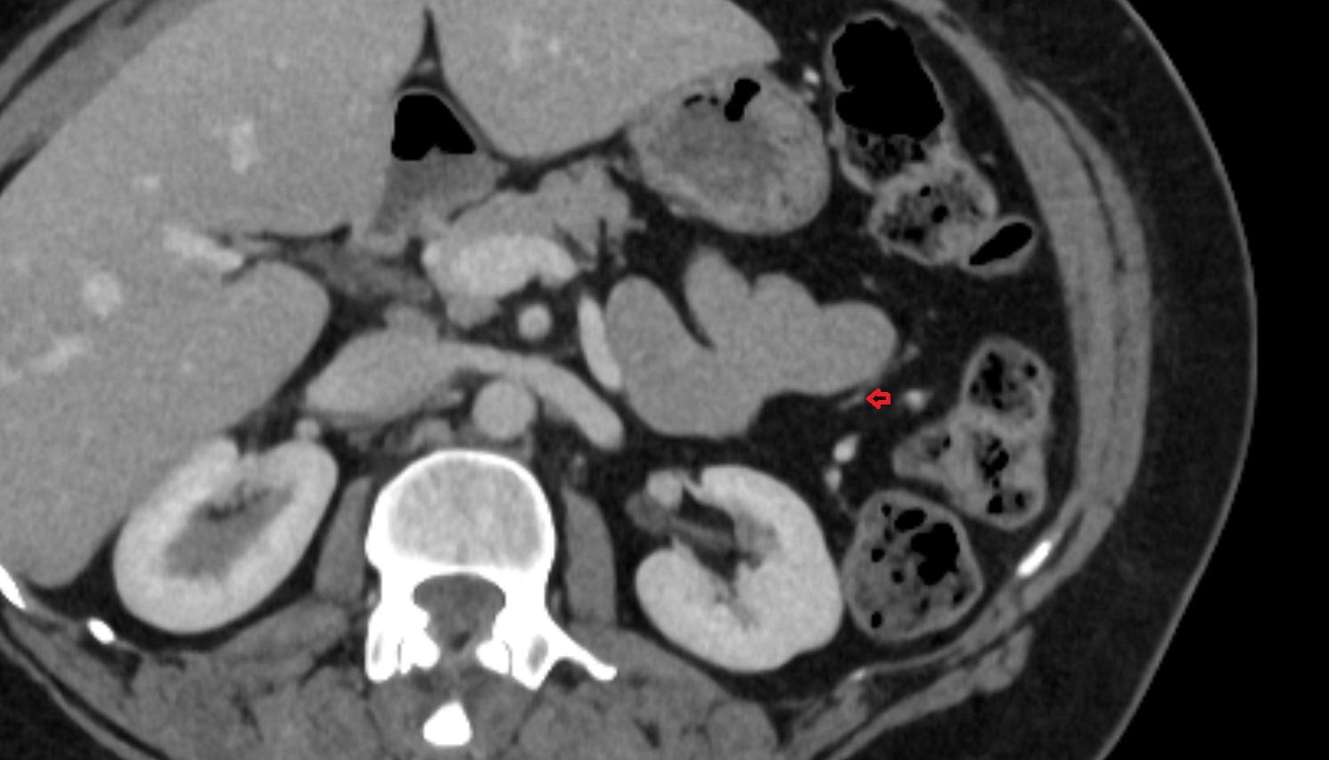 Left colic artery CT axial anatomy  image -img-00000-00000