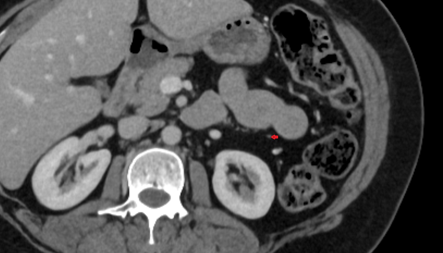 Left colic artery CT axial anatomy  image -img-00000-00000_00001