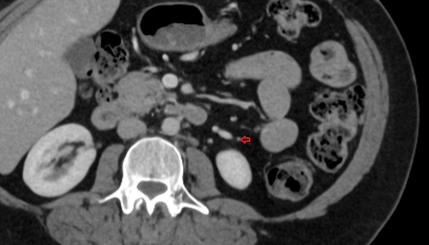 Left colic artery CT axial anatomy  image -img-00000-00000_00002