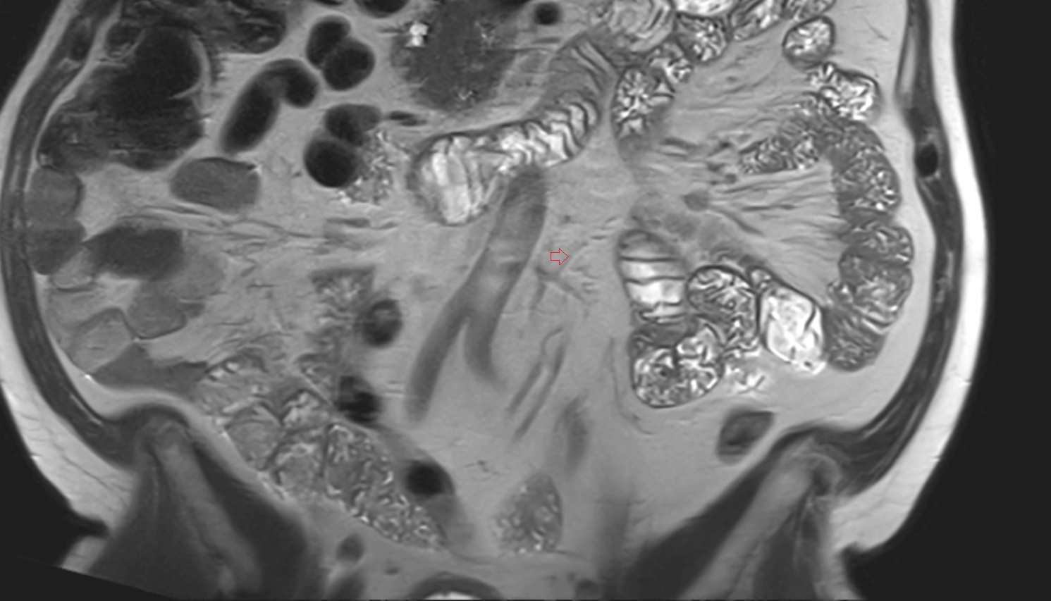 Left colic artery MRI coronal anatomy  image -img-00000-00000