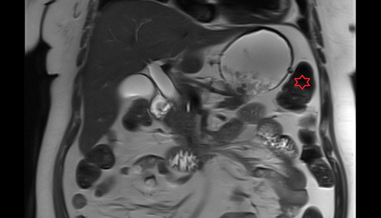 Left colic flexure (splenic flexure)  MRI coronal anatomy  image-img-00000-00000