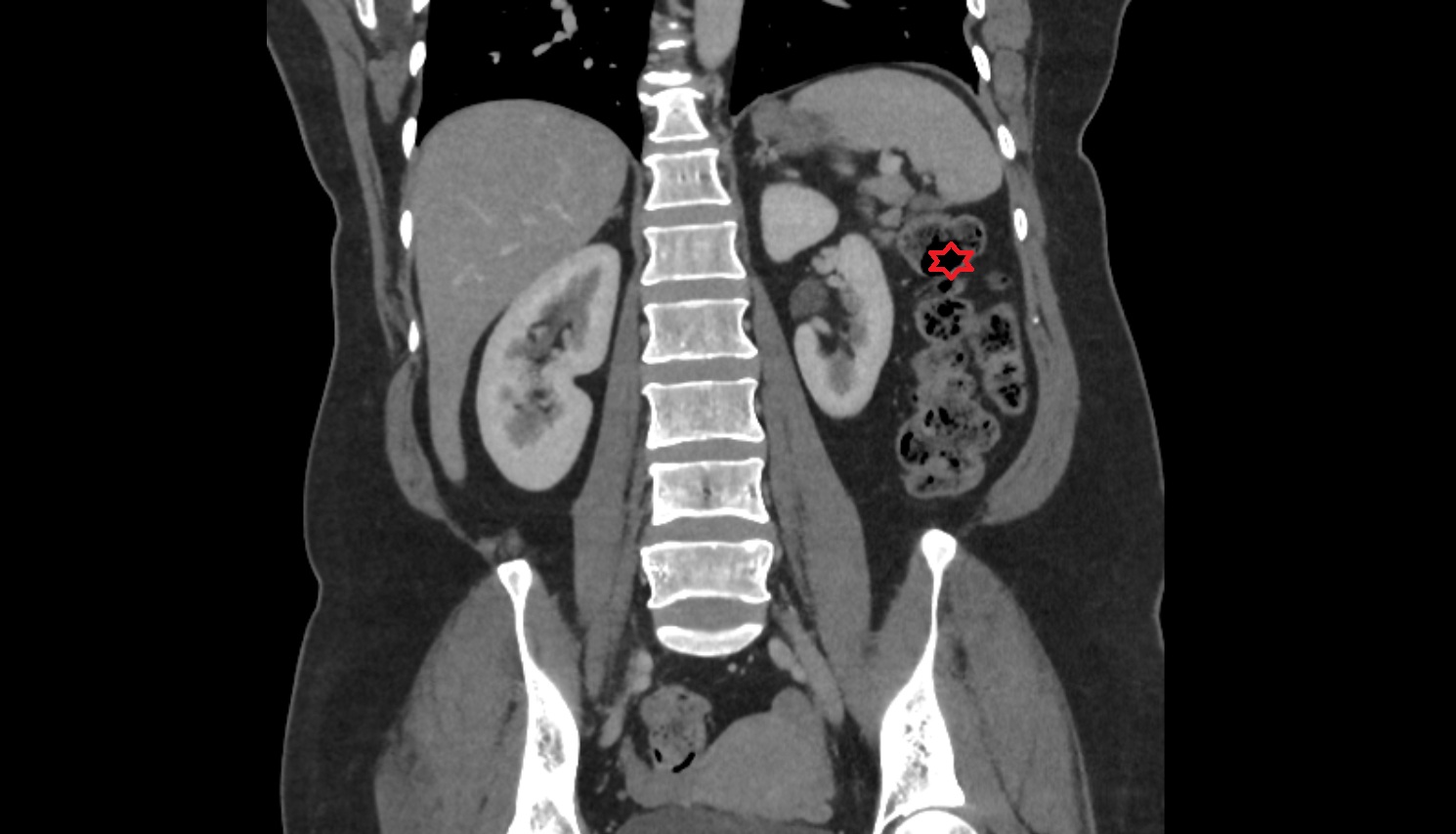 Left colic flexure (splenic flexure)  ct  coronal anatomy  image-img-00000-00000