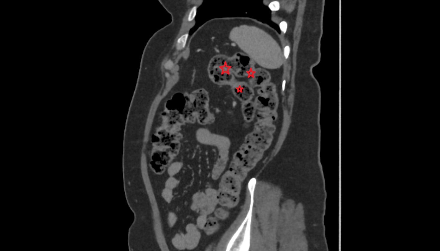 Left colic flexure (splenic flexure)  ct  sagittal  anatomy  image-img-00000-00000