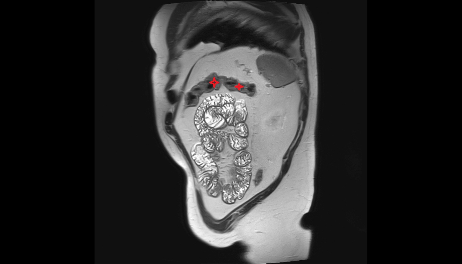 Left colic flexure (splenic flexure)  mri  sagittal  anatomy  image-img-00000-00000