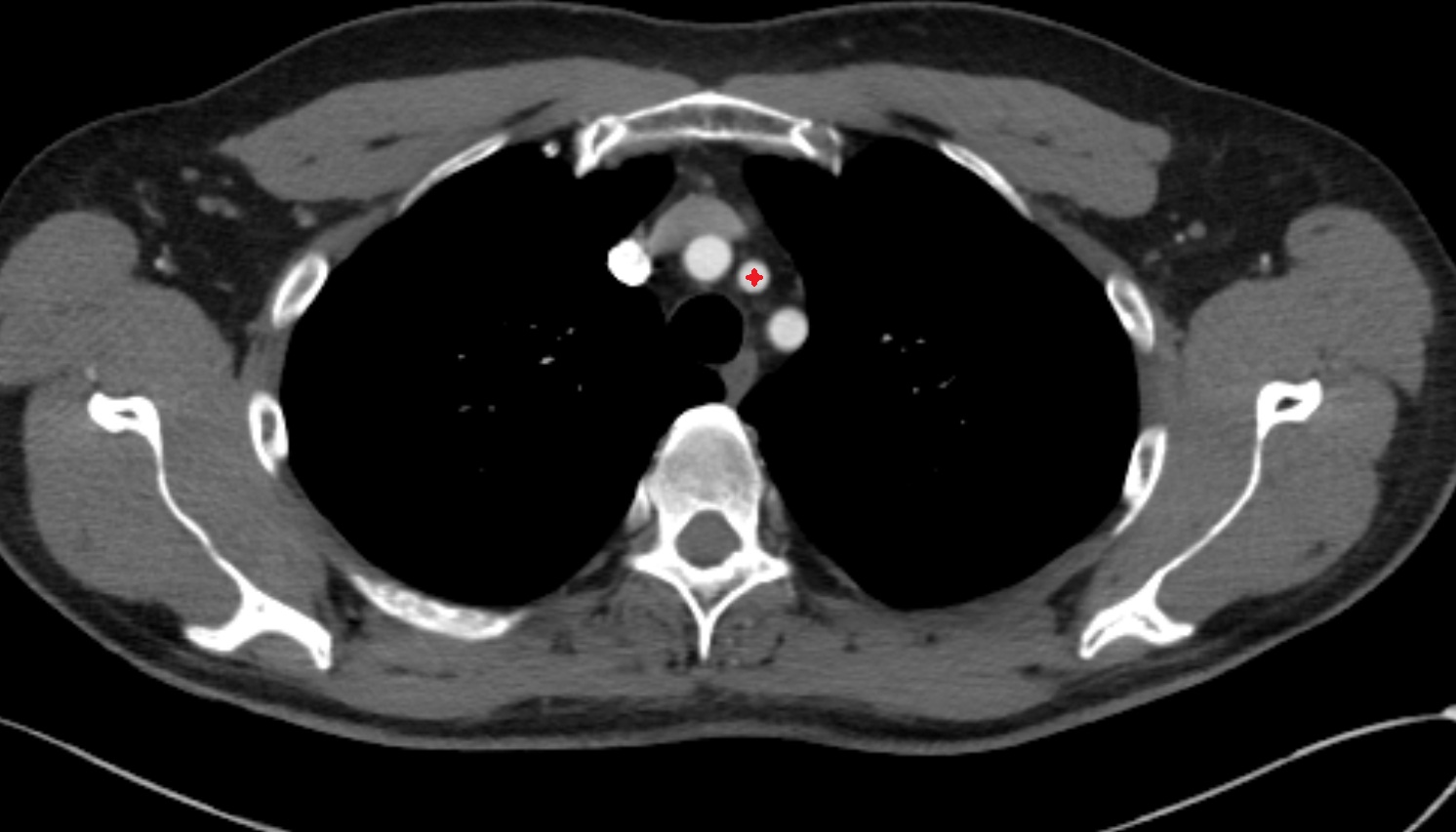 Left common carotid arteryCT axial  image -img-00000-00000