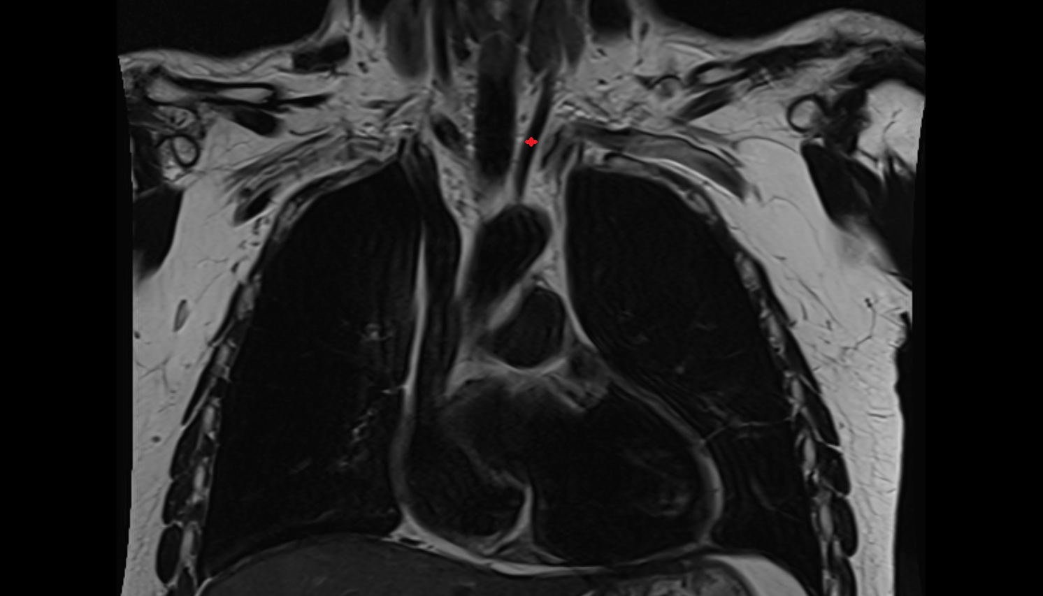 Left common carotid artery MRI  coronal  image -img-00000-00000