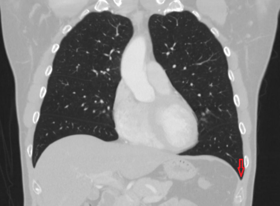 Left costophrenic angle ct Anatomy, Location and Imaging Appearance