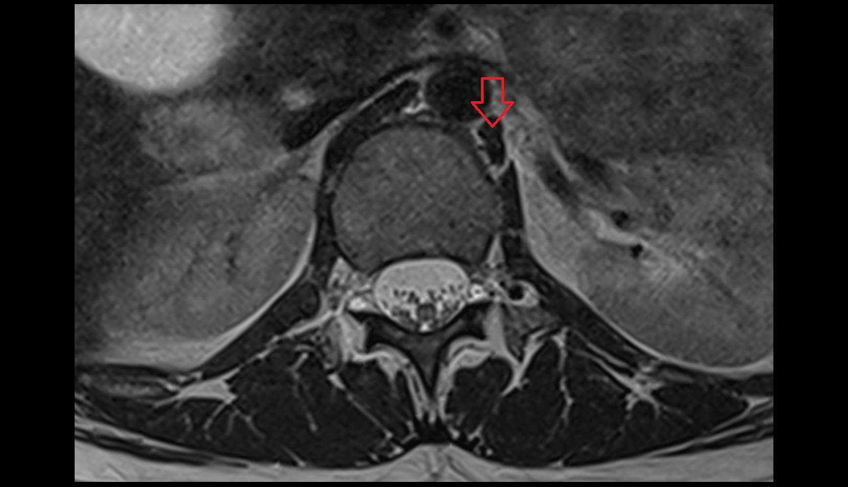 Left crus of diaphragm mri axial image