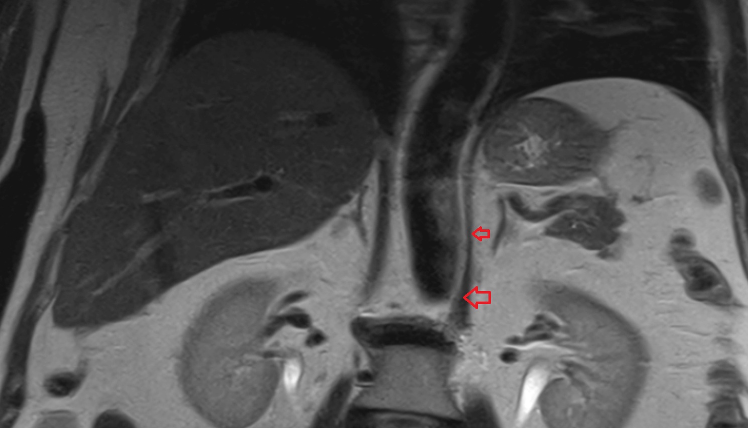 Left crus of diaphragm mri coronal   anatomy  image-img-00000-00000