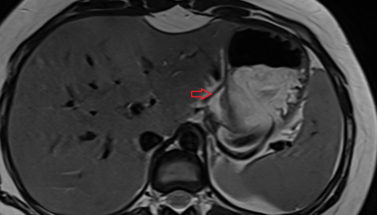 Left gastric artery anatomy MRI axial   image -img-00000-00000